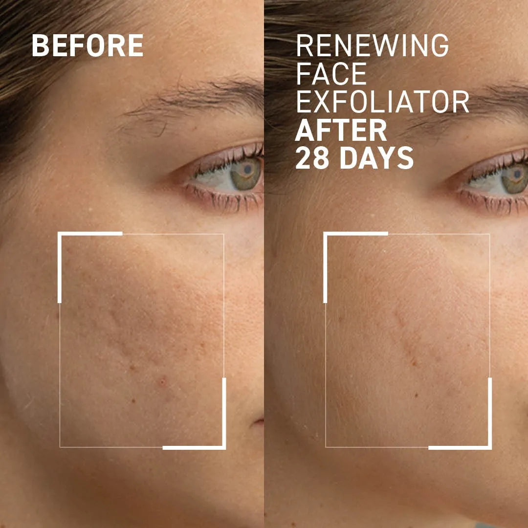 Result of using Dr Brandt Microdermabrasion Body Exfoliator - reduced texture and fine lines on face and body